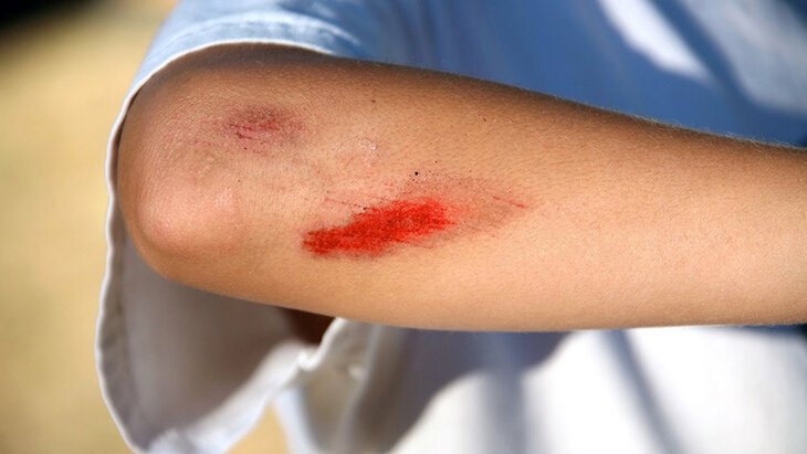 Nguyên nhân vết thương không khô: Các yếu tố ảnh hưởng và giải pháp điều trị